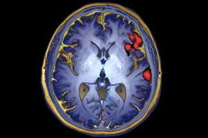 Brain activity in speech production shown on a coloured functional magnetic resonance imaging (MRIf) scan