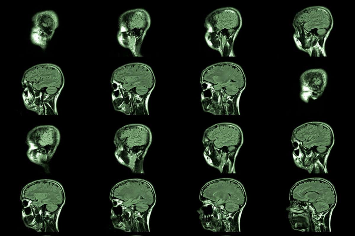 magnetic resonance imaging, MRI MRT head